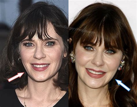 zooey deschanel facelift|Zooey Deschanel Before And After: Zooey’s。